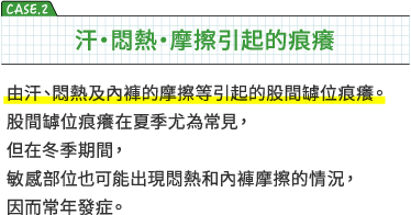 CASE2 汗・悶熱・摩擦引起的痕癢　由汗、悶熱及內褲的摩擦等引起的胯部痕癢。胯部痕癢在夏季尤為常見，但在冬季期間，敏感部位也可能出現悶熱和內褲摩擦的情況，因而常年發症。